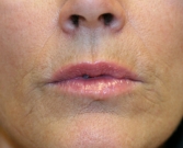 Feel Beautiful - Lip Lines (fine creases around lips) - Before Photo